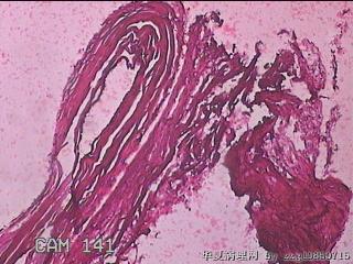 右输卵管系膜囊肿图7