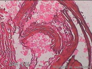 右输卵管系膜囊肿图28