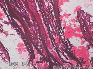 右输卵管系膜囊肿图4