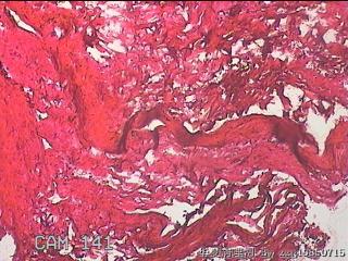 右输卵管系膜囊肿图23