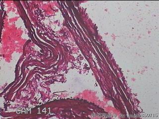 右输卵管系膜囊肿图6