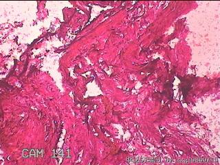 右输卵管系膜囊肿图13