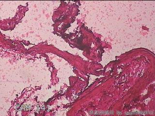 右输卵管系膜囊肿图14