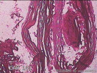 右输卵管系膜囊肿图9