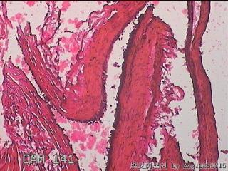 右输卵管系膜囊肿图27
