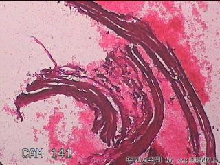 右输卵管系膜囊肿图18