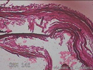 右输卵管系膜囊肿图2