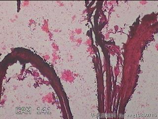 右输卵管系膜囊肿图20