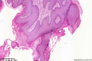 外阴赘生物，尖锐湿疣？寻常疣？图8
