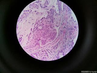 胃窦粘膜图5