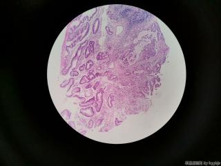 胃窦粘膜图4