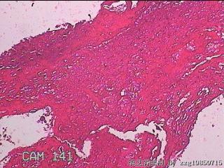 宫腔内赘生物图21