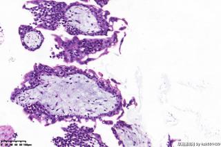 请老师们帮看看这个宫内膜，需要排除葡萄胎吗？图10