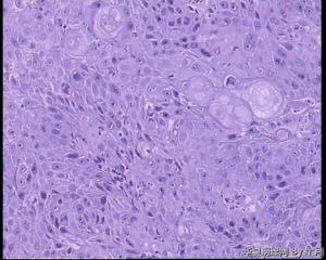 口腔黏膜溃疡活检（高分化鳞癌？）图7