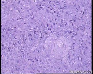 口腔黏膜溃疡活检（高分化鳞癌？）图6