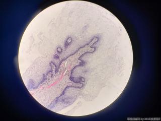 22岁，肛周赘生物图9