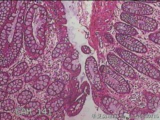 直乙结肠粘膜图6