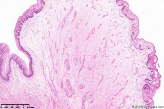 肛门包块，纤维上皮性息肉伴内痔，局部区域上皮乳头瘤样增生？图19