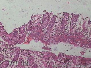 降乙结肠粘膜图6