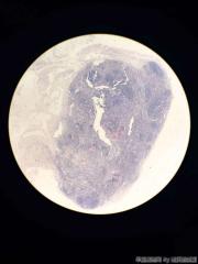 肝包虫，胆囊颈部淋巴结图6