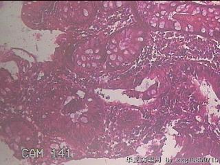 升结肠粘膜图13