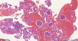 子宫内膜，间质细胞增生明显图6
