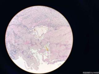胆囊壁层见粘液图3