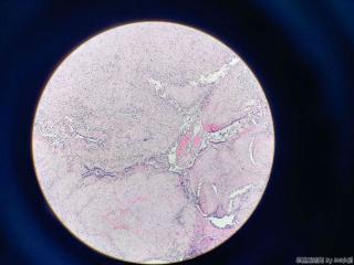 胆囊壁层见粘液图5