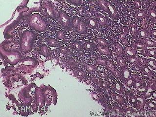 胃窦粘膜图4