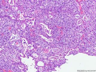 宫颈少见病例--浸润性复层产粘液性癌ISMC？？？？？图6