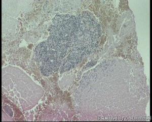子宫内膜结核图4