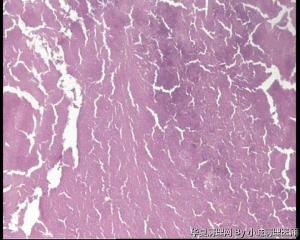 子宫内膜结核图1