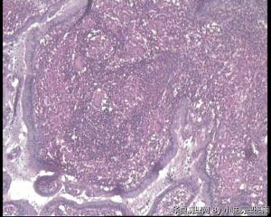 子宫内膜结核图9