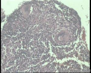 子宫内膜结核图6