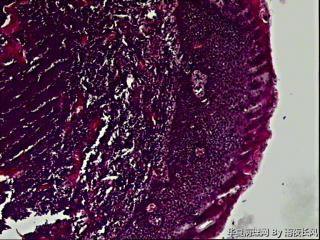 咽喉赘生物。请教各位老师图7