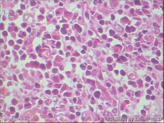 浆细胞性乳腺炎图5