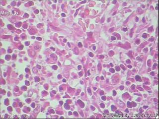 浆细胞性乳腺炎图4