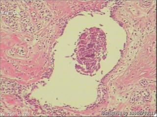 浆细胞性乳腺炎图3