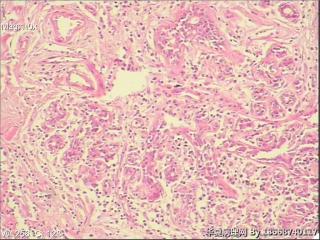 浆细胞性乳腺炎图7