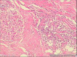 浆细胞性乳腺炎图8
