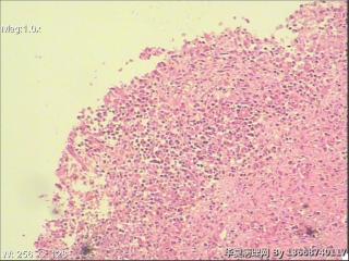浆细胞性乳腺炎图6