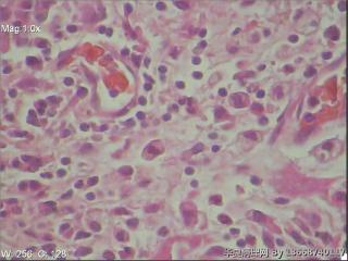 浆细胞性乳腺炎图2