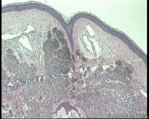 又传了几张图片，请老师看看眉头黑色素痣，真皮深层黑色素细胞有点不放心图5