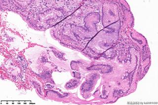 增生性息肉伴肠化、糜烂？图6