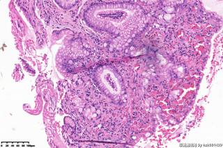 增生性息肉伴肠化、糜烂？图10