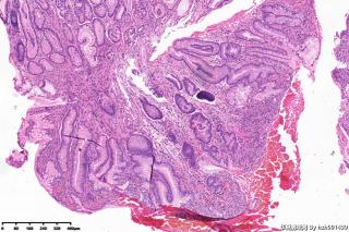 增生性息肉伴肠化、糜烂？图2