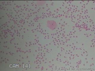 宫颈湿疣样变；高危HPV16感染图24