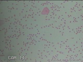 宫颈湿疣样变；高危HPV16感染图19