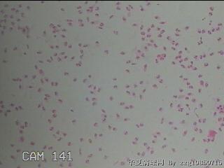 宫颈湿疣样变；高危HPV16感染图1