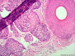 毛母细胞瘤？汗腺瘤？图3